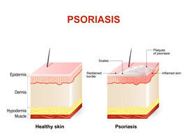 Učinkovito djelovanje Psorilax na bilo kakve iritacije